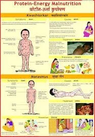 Protein Energy Malnutrition (Kwashiorkar & Marasmus) (50x70cm) product image