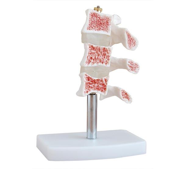 Osteoporosis Vertebrae Cutaway Model