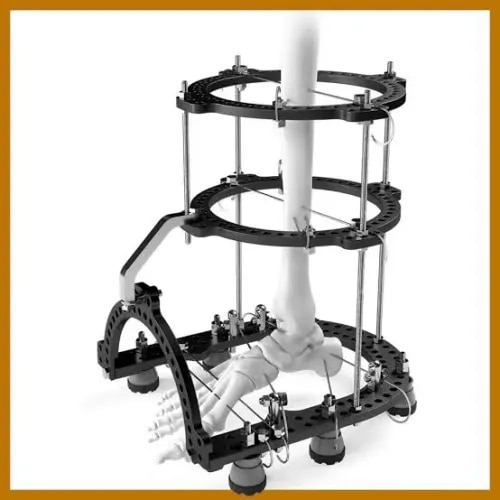External Fixator System