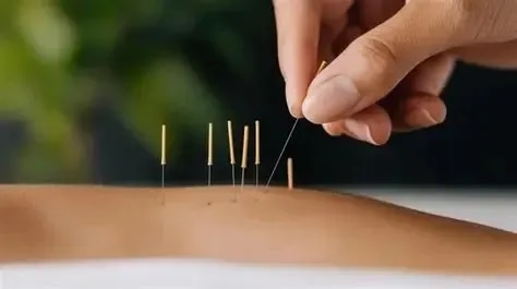 Accupuncture Needles
